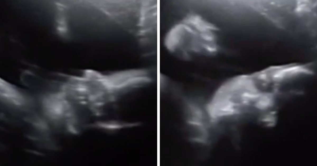 Przyszła mama zrobiła USG. To, co zobaczyła na ekranie przeszło jej najśmielsze oczekiwania