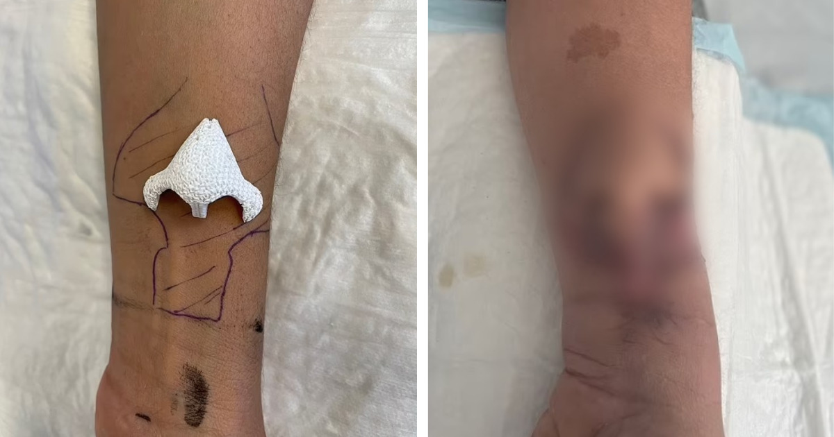 Lekarze "wyhodowali" nowy nos na przedramieniu 50-letniej pacjentki