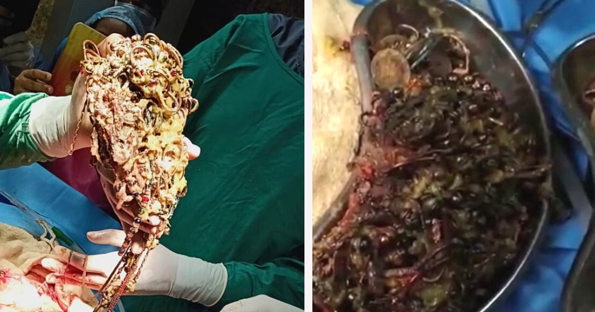 Lekarze byli zdumieni, gdy zobaczyli co znajduje się w żołądku pacjentki.